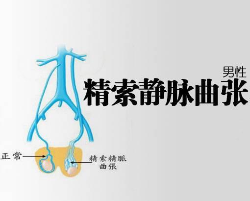精索静脉曲张的起因